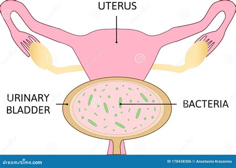 Uterine Polyps. Human Realistic Uterus. Anatomy Illustration Stock Illustration - Illustration ...