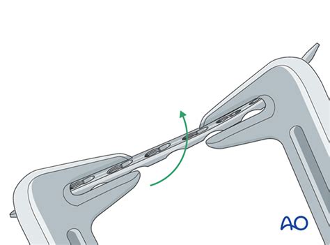 Limited Contact Dynamic Compression Plate 的图像结果