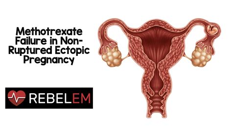 Methotrexate Failure in Non-Ruptured Ectopic Pregnancy - REBEL EM - Emergency Medicine Blog