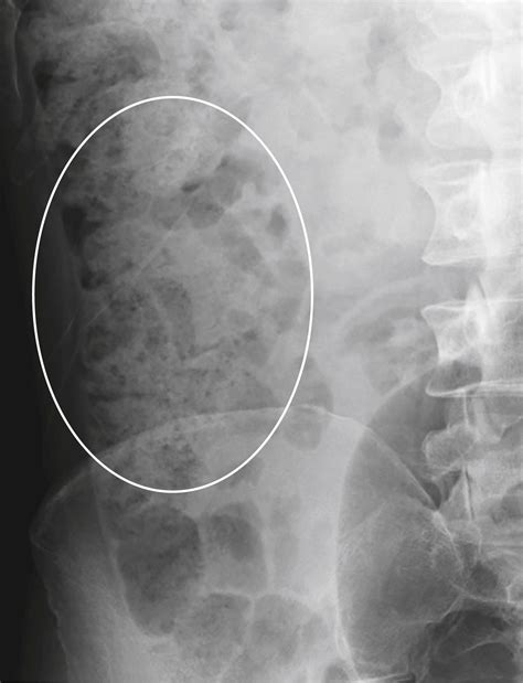 Recognizing the Normal Abdomen and Pelvis: Conventional Radiographs - Clinical Tree