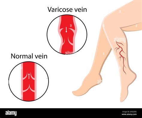 Varicose veins. Pain in the legs. Human Anatomy Stock Vector Image & Art - Alamy