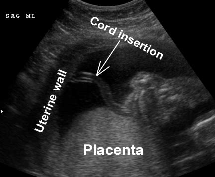Bildergebnis für velamentous umbilical cord ultrasound