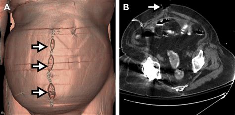 Imaging of Abdominal Postoperative Complications - Radiologic Clinics