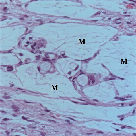 Ovarian Teratomas: Tumor Types and Imaging Characteristics | RadioGraphics