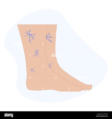 Varicose spider veins anatomy. Swelling and pain in human legs. Vascular disease diagnostic and ... - treat venous disease