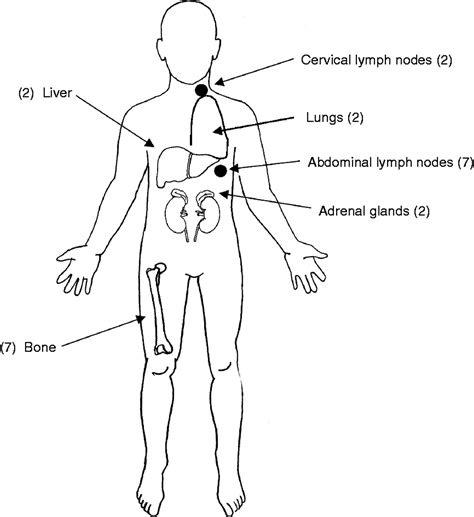 Succinate dehydrogenase gene mutations are strongly associated with ...