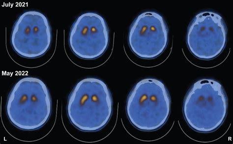 Immunophenotyping Tracks Motor Progression in Parkinson’s Disease Associated with a TH Mutation ...