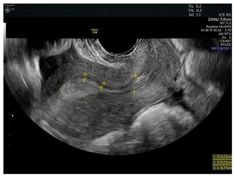 Effect of Treatment with Progestins and Antiplatelet Agents on IVF in ...