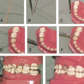 Image result for Transnasal Loop Fixation
