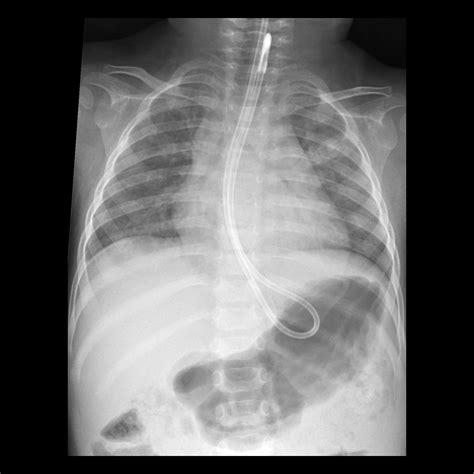 Pediatric Feeding Tube Malfunction / Malposition / Misposition ...