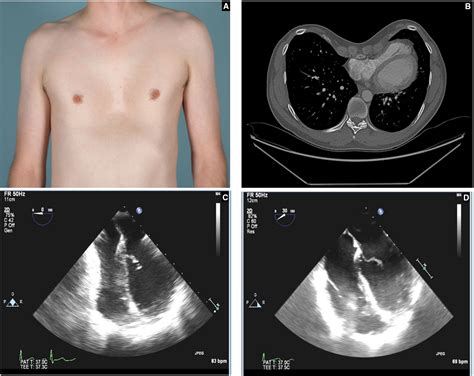 Cardiopulmonary Outcomes After the Nuss Procedure in Pectus Excavatum ...