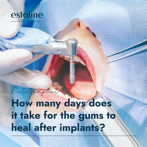 The process of gum healing after dental implants may vary between… | Estaline Clinic