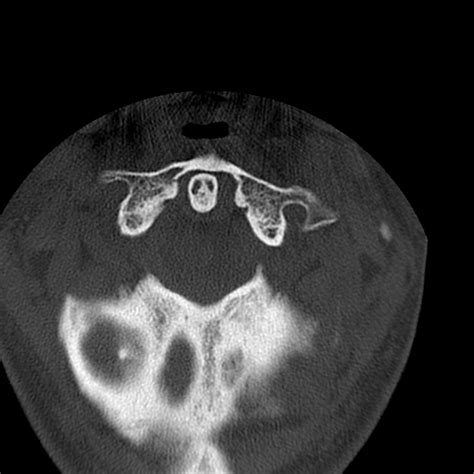 Occipital condyle fracture (Radiopaedia 31755-32691 Axial bone window ...