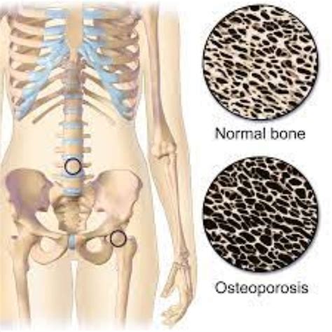 Is Osteoporosis Genetic? The Risks, the Factors, and What You Can Do ...