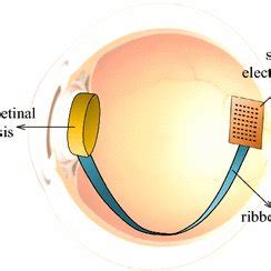 Image result for Visual Prosthesis Implant
