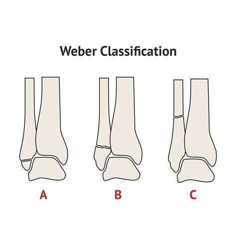 Weber Classification of Lateral Malleolar Fractures | Classification ...