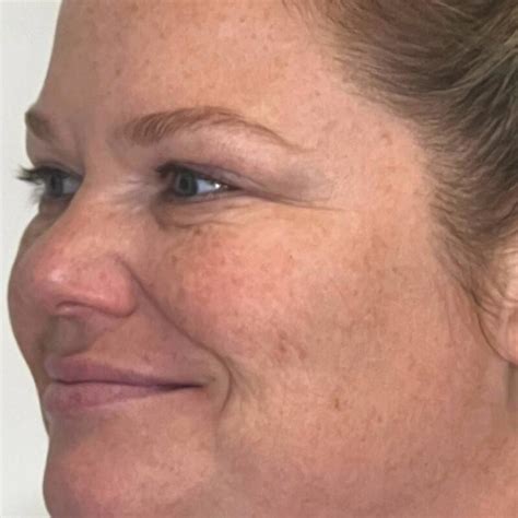 Image result for Botox Examples