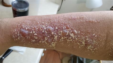 Does Showering Make Poison Ivy Worse at Fredia Mcintyre blog