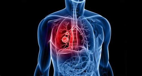 Revealed -- lung cancer can remain dormant for 20 years before ...