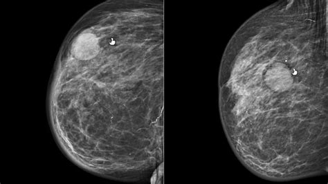 Quiste mamario: causas, síntomas, clasificación, diagnóstico y tratamiento