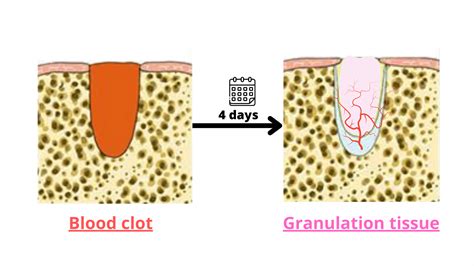 What does a blood clot after tooth extraction look like?