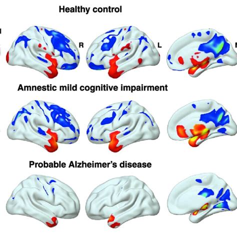 Statistical Parametric Mapping 的图像结果