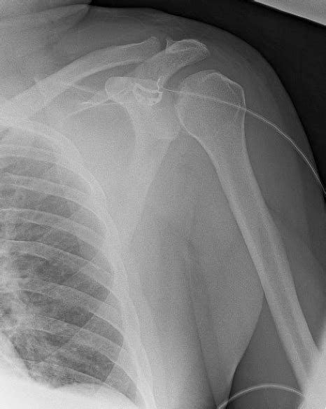 Image result for Posterior Shoulder Dislocation Sulcus Sign