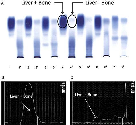 Bone-specific alkaline phosphatase by immunoassay or electrophoresis ...