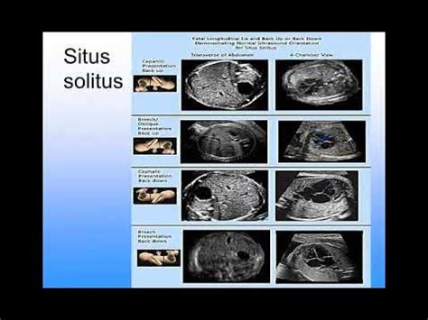 Image result for Fetalscreen II