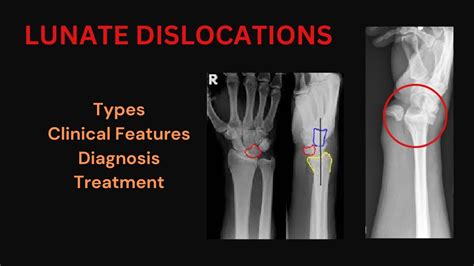 Image result for Lunate Dislocation Reduction