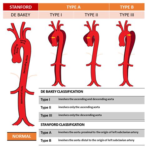 CT evaluation of aortic dissection and other acute aortic syndromes: An Update - MedCrave online