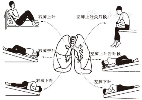 儿童支气管扩张症诊断与治疗专家共识-北京新世纪儿童医院