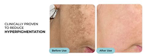 Shop Trubiom Pigmentation & Dark Spots Treatment Serum | 30 ml for ...