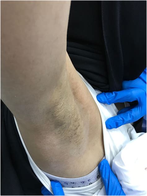 Fox-fordyce disease: Pulsed dye laser versus fractional Co2 laser treatment - JAAD Case Reports