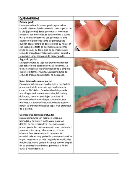 Quemaduras - UNIDAD DE QUEMADOS - QUEMADURAS Primer grado Una quemadura ...