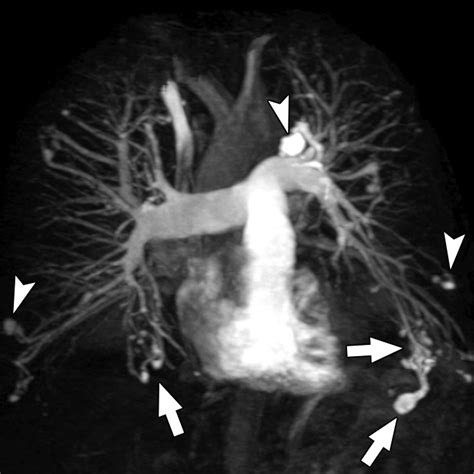 MR Angiography for Detection of Pulmonary Arteriovenous Malformations in Patients with ...