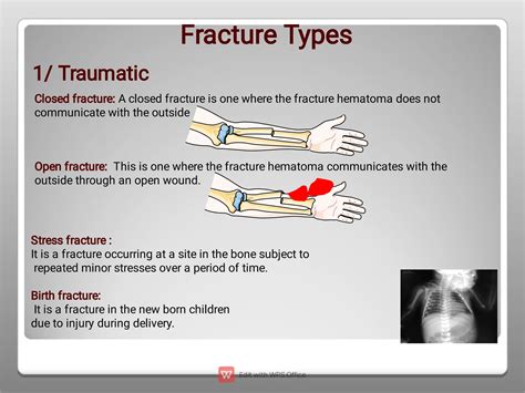 Definition of fracture it's types , symptoms and treatment | PDF