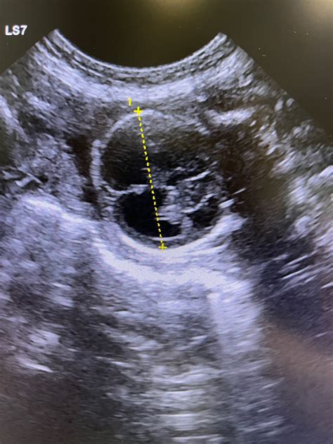 Fetal hydrocephalus. Ultrasound diagnostics in the 7th week of ...