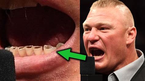 What's Wrong with Brock Lesnar's Teeth? 10 Shocking Things on WWE ...