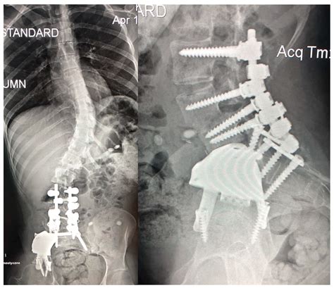 Clinical Consequences of Unreconstructed Pelvic Defect Caused by ...