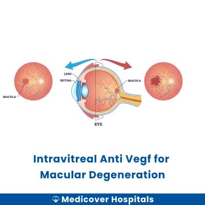 Procedimiento intravítreo anti-VEGF para la degeneración macular ...
