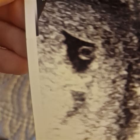 6 week scan, anyone had fluid in their uterus? | BabyCenter