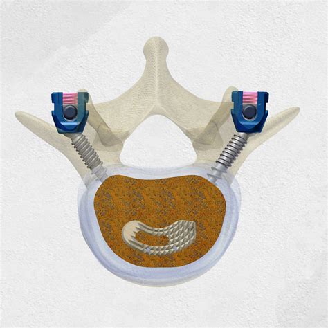 Image result for Spinal Fixation