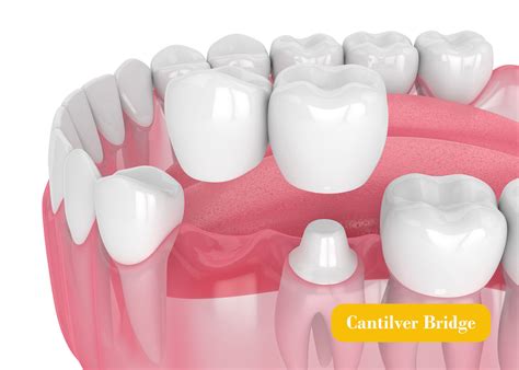 Cantilever Dental Bridge Nhs at Michael Siddons blog