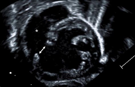 Imaging of Double Inlet Left Ventricle - Seminars in Thoracic & Cardiovascular Surgery ...