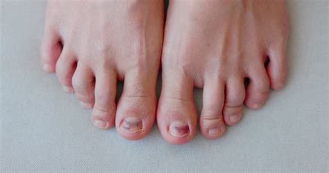 Subungual Hematoma on toenail are injuries of wearing shoes that are ...