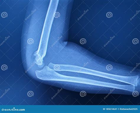 X Ray Elbow Joint Effusion at Pearl Murray blog