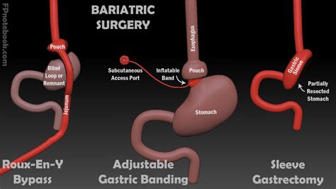 Lap Band Surgery Esophagus at Helen Porter blog