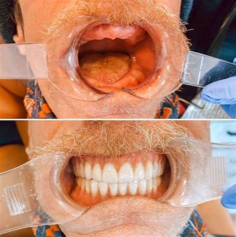 Image result for Dentures Look Real