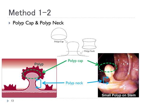 Image result for Polyp Detection Device